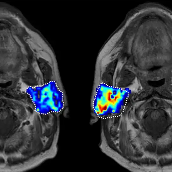 MRI Parotid Gland With Contrast